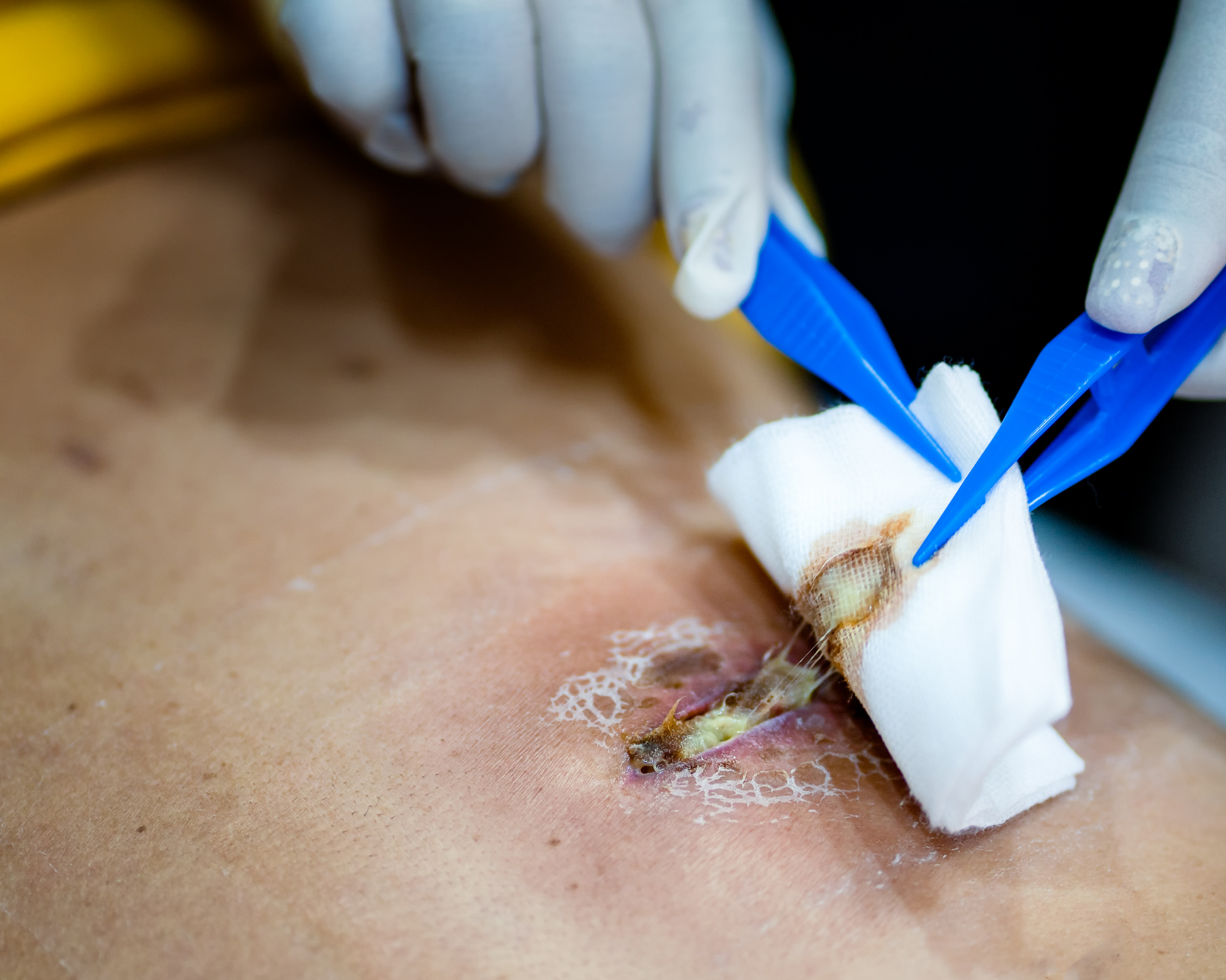 Küçük Cerrahi Müdahaleler